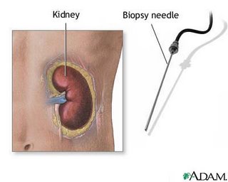  Nephrotic_Syndrome (9).jpg